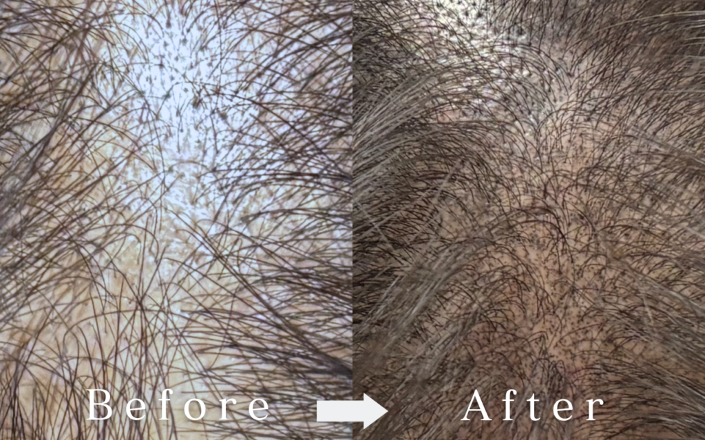 Tokyo Azabu-Juban salon - Scalp Ink - thinning hair - aging hair - scalp art makeup
