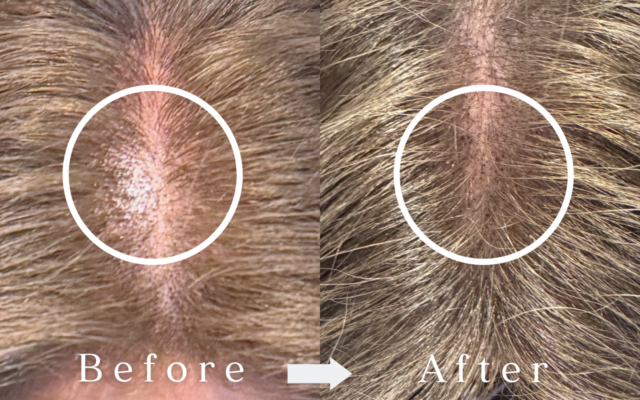 Scalp Ink Before & After | Female - Parting Shadow Expression