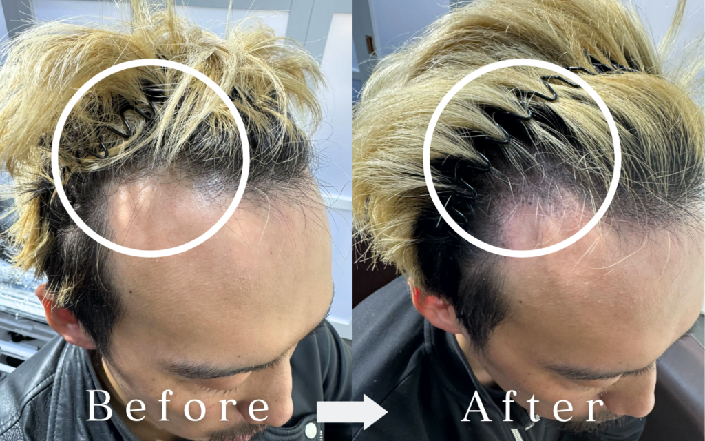 Tokyo Azabu-Juban salon - Scalp Ink - thinning hair - aging hair - scalp art makeup