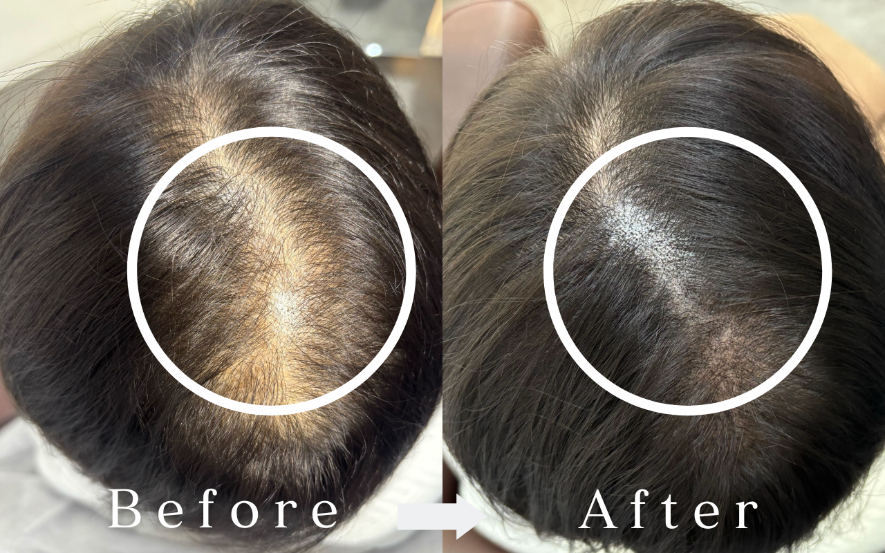 Scalp Ink Before & After | Female - Crown and Whorl Shadow Expression