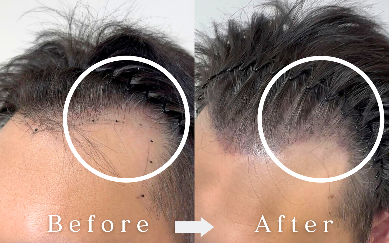 Scalp Ink Before & After | Male - Hairline Shadow Expression