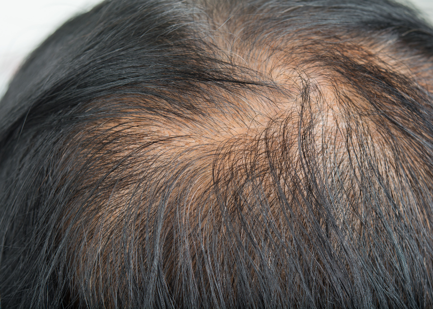 Who is Scalp Ink recommended for? - bondzsalon