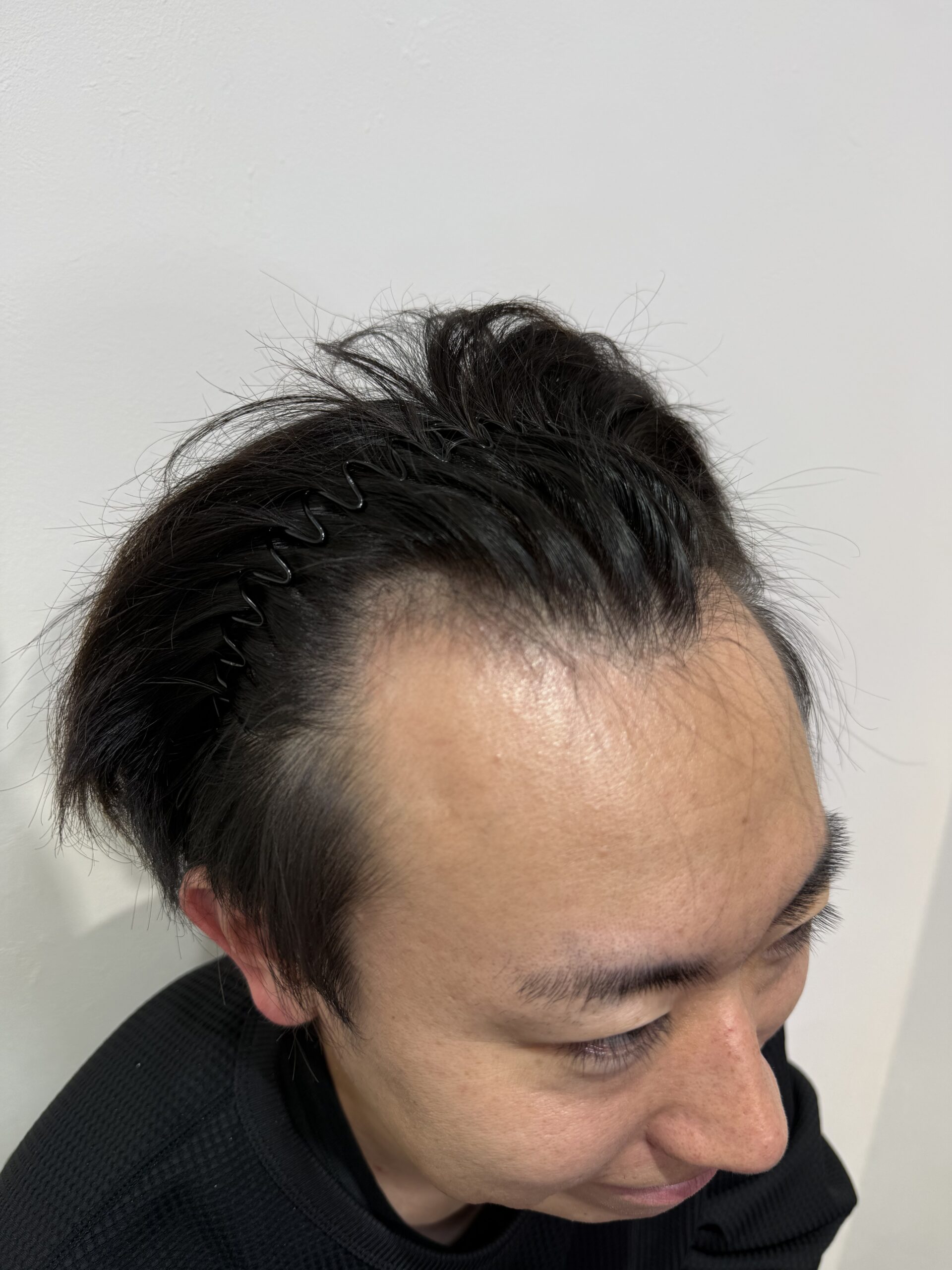 M字生え際 施術前